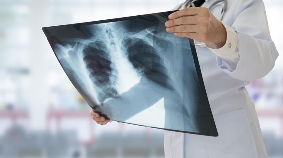 Medical person looking at an x-ray sheet of a rib cage